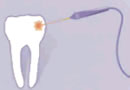 http://www.dentalcare-indiatour.com/images/laser.jpg